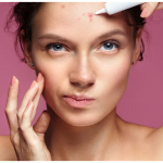 How To Get Rid Of Acne- Tips To Follow.